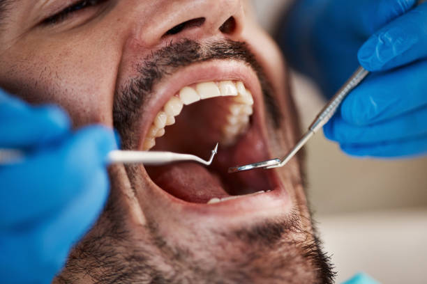 Best Knocked-Out Tooth (Avulsed Tooth) Treatment in Piney Green, NC